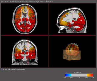swLORETA brainmap anxious patient with ADHD
