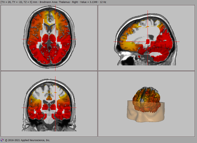 Brain image swLORETA for Neurofeedback